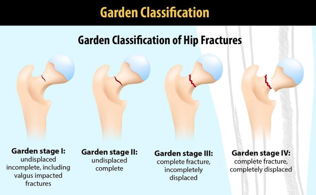 Garden's classification of femoral fractures